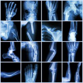 New Clues on Vitamin D and Bone Fractures