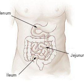Number of SNPs Associated with Crohn’s Disease Triples