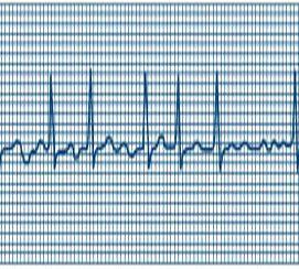 Genetics found to influence resting heart rate
