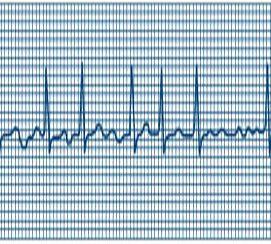 The Ancestry Link For Atrial Fibrillation Risk