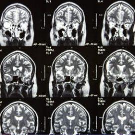 Genetic Associations with Brain Aneurysm