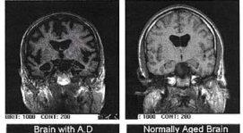 Early Detection, Prediction, and Prevention of Alzheimer’s Disease