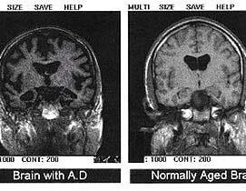 A Genetic Variant Protective Against Alzheimer’s