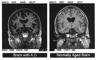 alzheimers brain