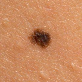New Studies On Breast Cancer Risk
