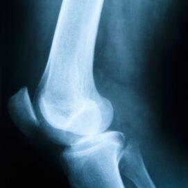 Genetic Influences on Bone Density and Fractures