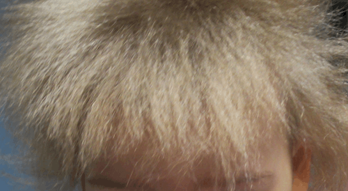 Scalp_hair-uncombable_hair_syndrome (1)