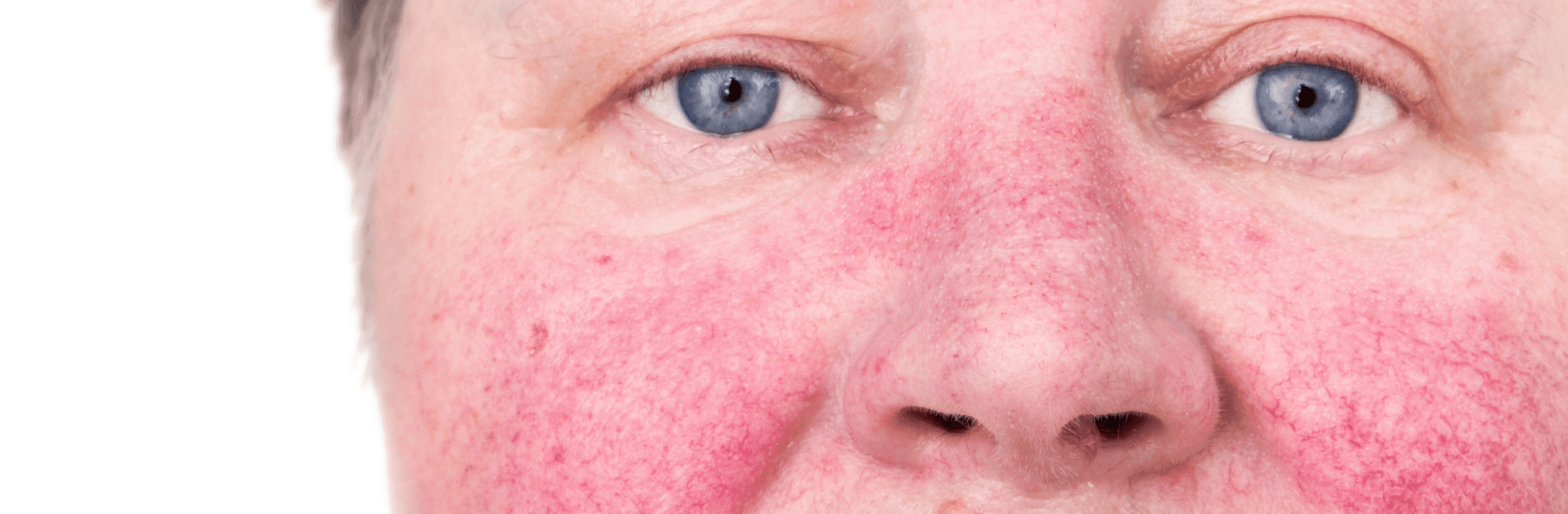 Rosacea wide