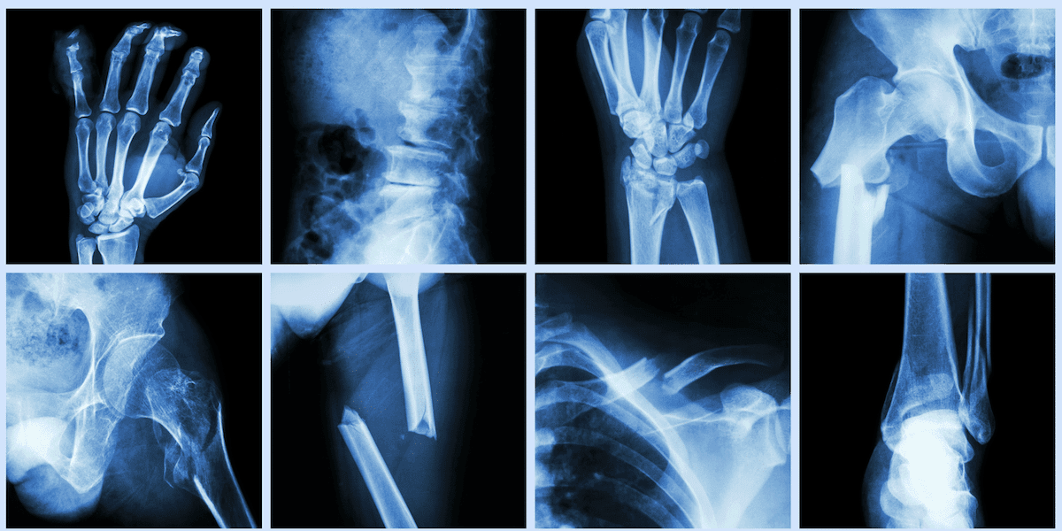 Bone Fractures Wide