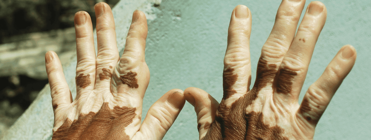 Study digs into why loss of skin pigmentation from vitiligo also reduces skin cancer risk