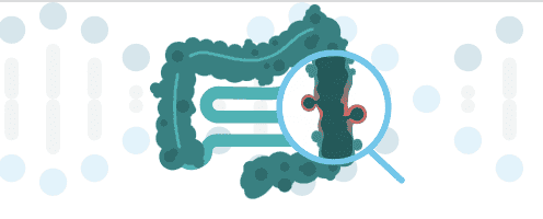 23andMe+ Premium Report on Diverticulitis
