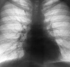 23andMe to Study Idiopathic Pulmonary Fibrosis