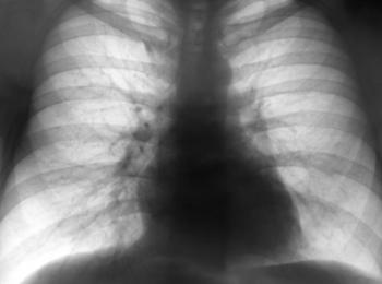 lung_xray