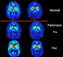 Large Study Offers Insight into Parkinson’s