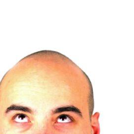 The role of genetics in male-pattern baldness