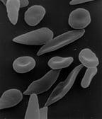New Research on Sickle Cell Trait