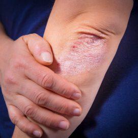New genetic variants found to influence psoriasis risk