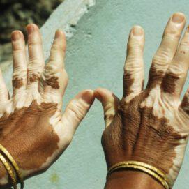 Study digs into why loss of skin pigmentation from vitiligo also reduces skin cancer risk