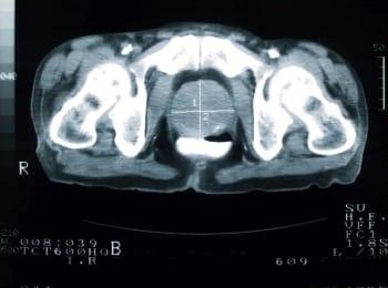 Understanding Prostate Cancer