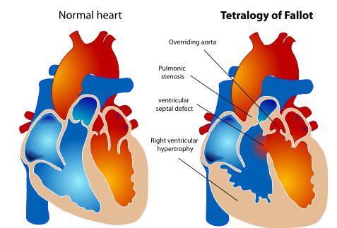 Genetic Associations with “Blue Babies”