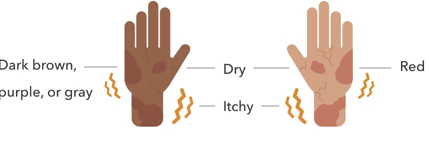 An illustration of symptoms of eczema on a person's hands